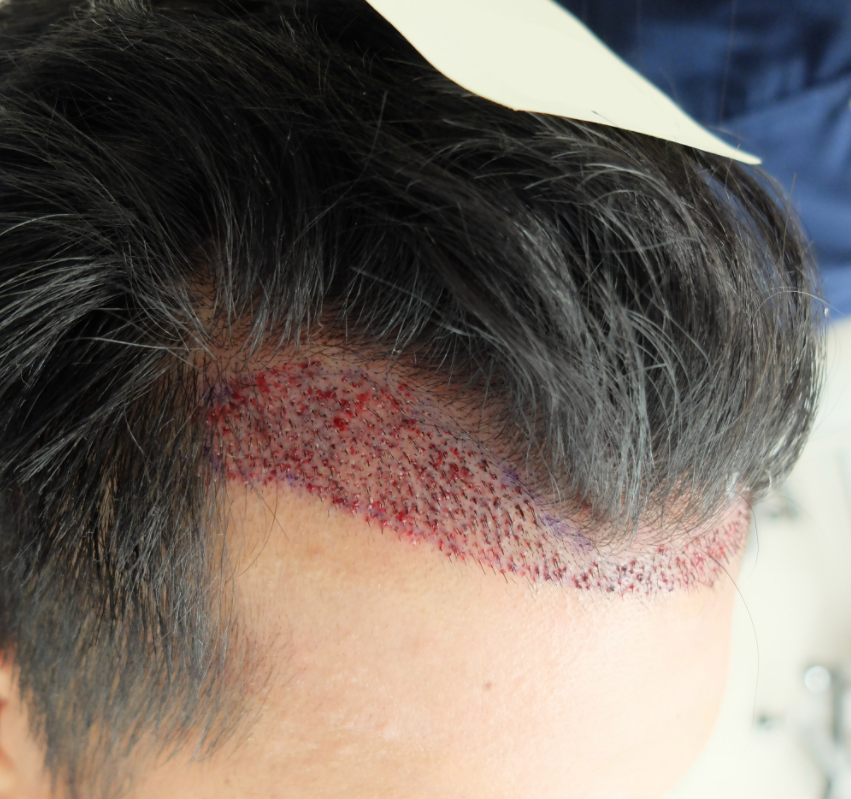 haartransplantation blog-9