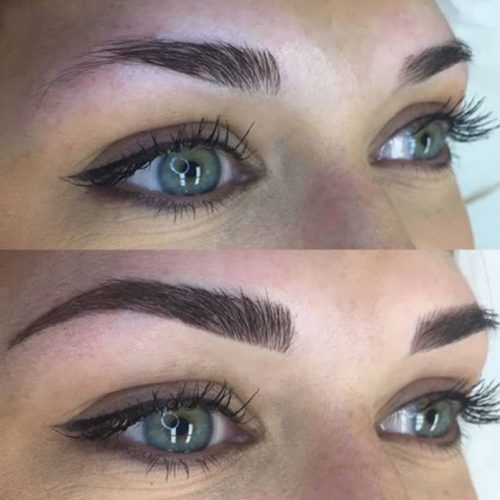 hairtransplant eyebrow