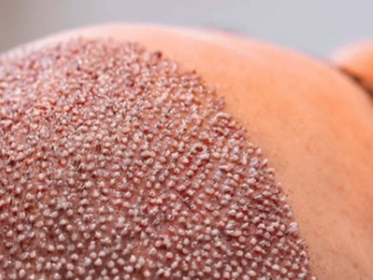Hair Transplant - Surgery Procedure, Type & Side Effects