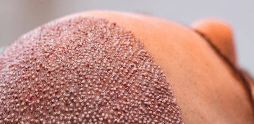 When Does Scab Shedding After Hair Transplantation