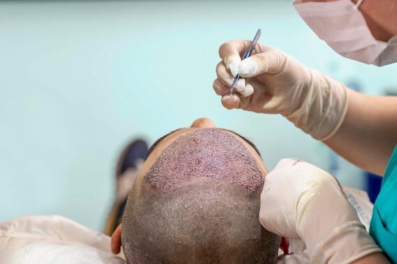 hair transplant risk