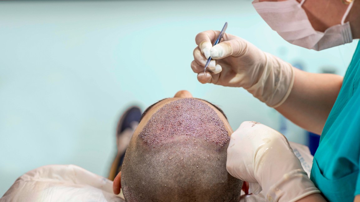 hair transplant risk