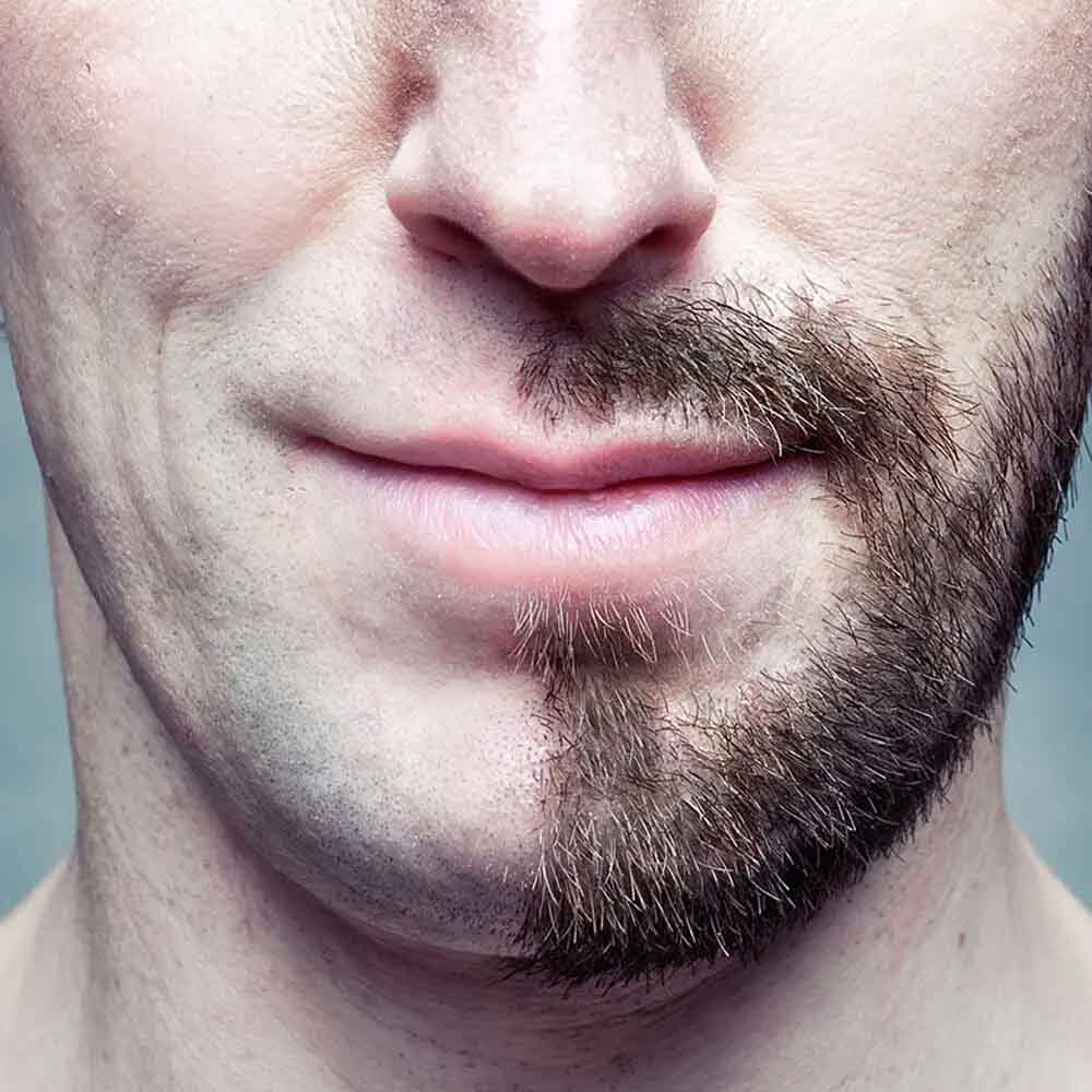 Beard Transplant