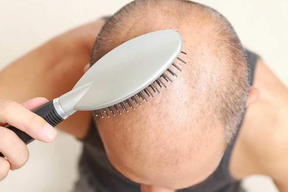 saç ekimi ölüm riski